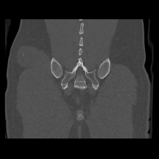 Chondrosarcoma of iliac wing (Radiopaedia 63861-72599 Coronal bone window 96).jpg