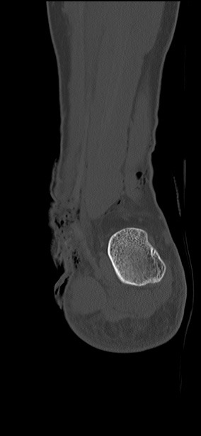 Chopart fracture (Radiopaedia 35347-36851 Coronal bone window 17).jpg