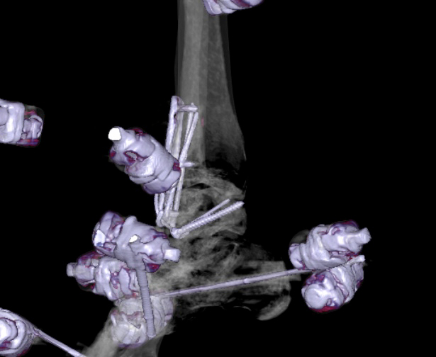 File:Chopart fracture (Radiopaedia 35347-36861 3D MPR bone window 16).jpg