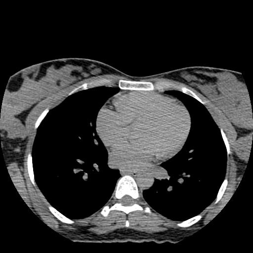 File:Choriocarcinoma of ovary with cerebral and pulmonary metastases (Radiopaedia 25983-26119 Axial non-contrast 149).jpg