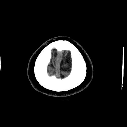 Choroid plexus xanthogranulomas (Radiopaedia 51621-57408 Axial non-contrast 112).jpg