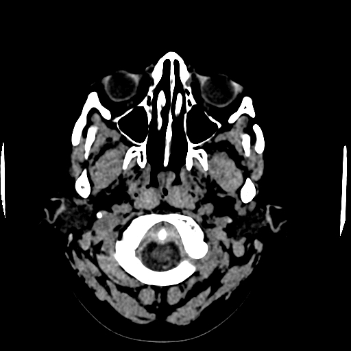 Choroid plexus xanthogranulomas (Radiopaedia 51621-57408 Axial non-contrast 2).jpg