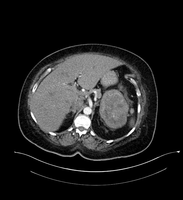 Chromophobe renal cell carcinoma (Radiopaedia 84239-99519 B 31).jpg