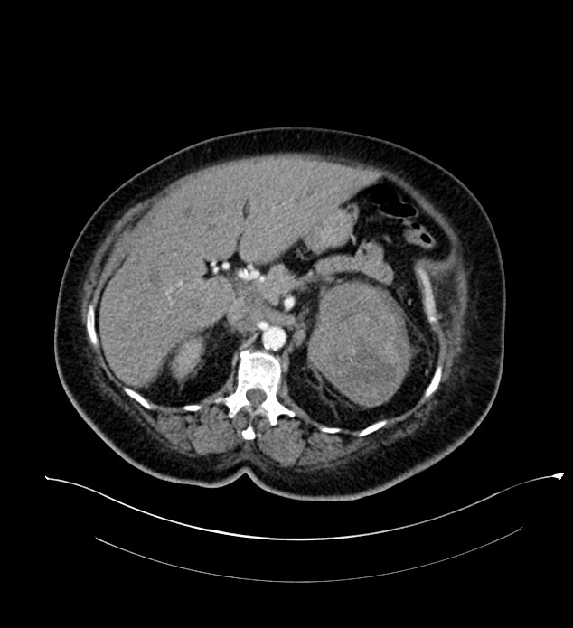 Chromophobe renal cell carcinoma (Radiopaedia 84239-99519 B 38).jpg