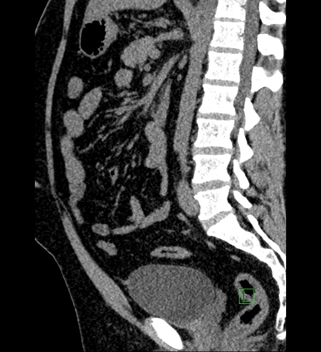 Chromophobe renal cell carcinoma (Radiopaedia 84286-99573 C 85).jpg