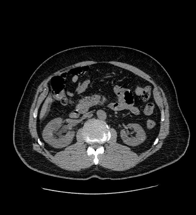 Chromophobe renal cell carcinoma (Radiopaedia 84337-99693 Axial non-contrast 54).jpg