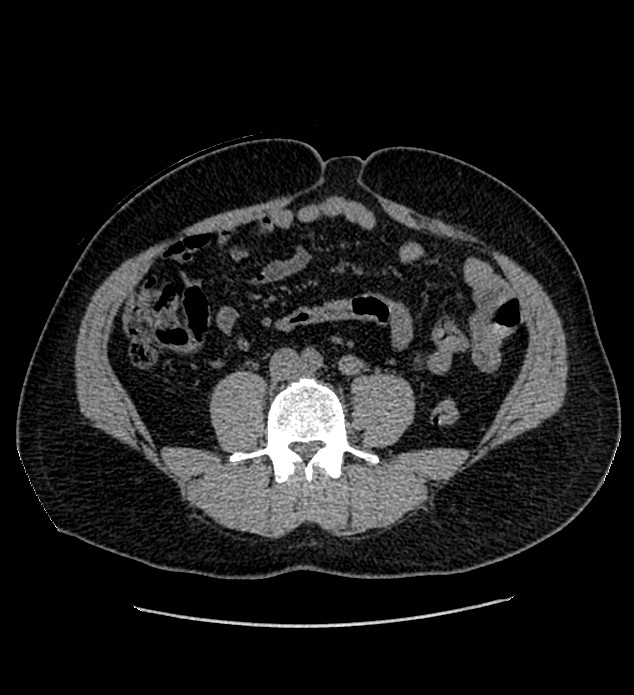 Chromophobe renal cell carcinoma (Radiopaedia 84337-99693 Axial non-contrast 91).jpg