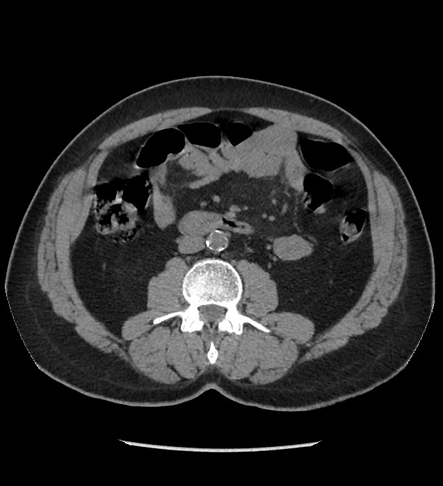 Chromophobe renal cell carcinoma (Radiopaedia 86879-103083 Axial non-contrast 54).jpg