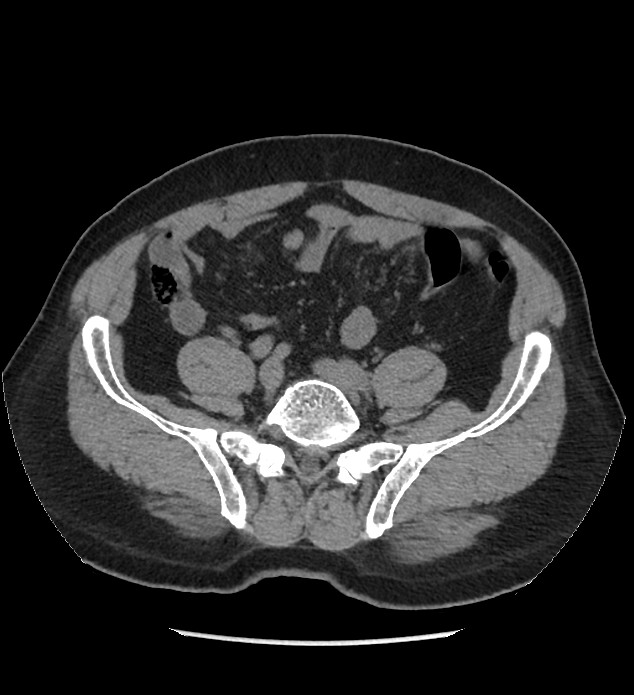 Chromophobe renal cell carcinoma (Radiopaedia 86879-103083 Axial non-contrast 87).jpg