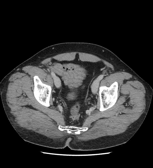 Chromophobe renal cell carcinoma (Radiopaedia 86879-103083 C 135).jpg
