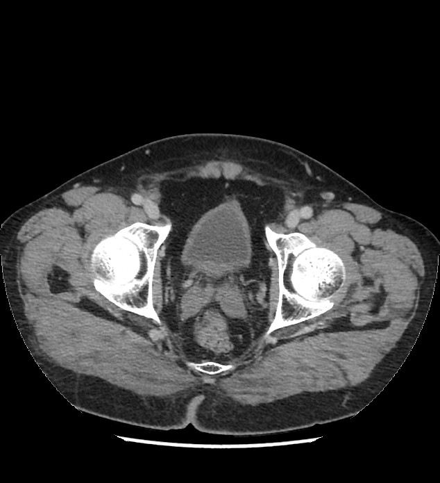 Chromophobe renal cell carcinoma (Radiopaedia 86879-103083 C 143).jpg