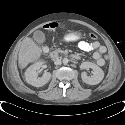 Chronic diverticulitis complicated by hepatic abscess and portal vein thrombosis (Radiopaedia 30301-30938 A 44).jpg