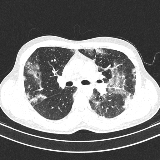 File:Chronic eosinophilic pneumonia (Radiopaedia 39331-41587 Axial lung window 22).png