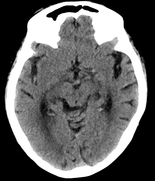 File:Chronic hypertensive encephalopathy (Radiopaedia 39993-42485 Axial non-contrast 15).png