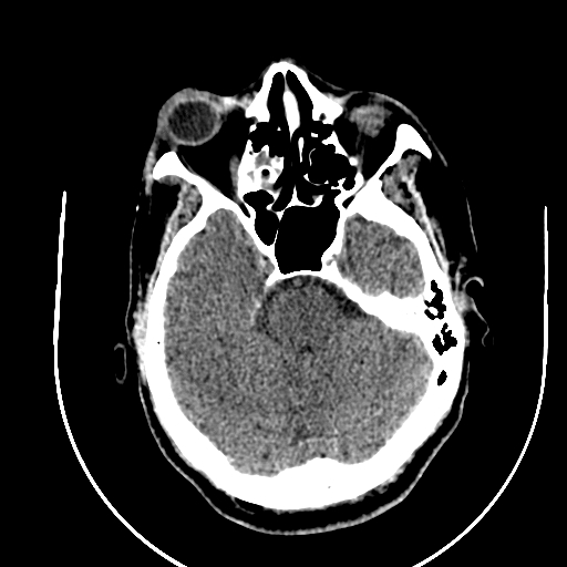 Chronic invasive fungal sinusitis (Radiopaedia 91563-109286 Axial non-contrast 29).jpg