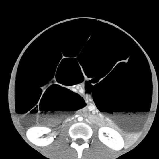 Chronic large bowel pseudo-obstruction (Radiopaedia 43181-46492 A 93).jpg