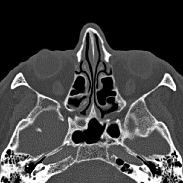 Chronic maxillary sinusitis (Radiopaedia 27879-28116 Axial bone window 28).jpg