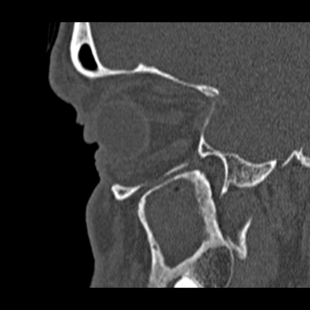 Chronic maxillary sinusitis (Radiopaedia 27879-28116 Sagittal bone window 10).jpg
