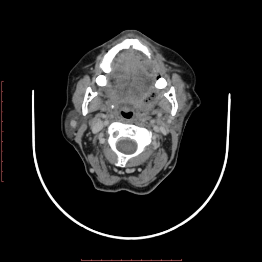 File:Chronic osteomyelitis - maxilla (Radiopaedia 23783-23927 B 49).jpg