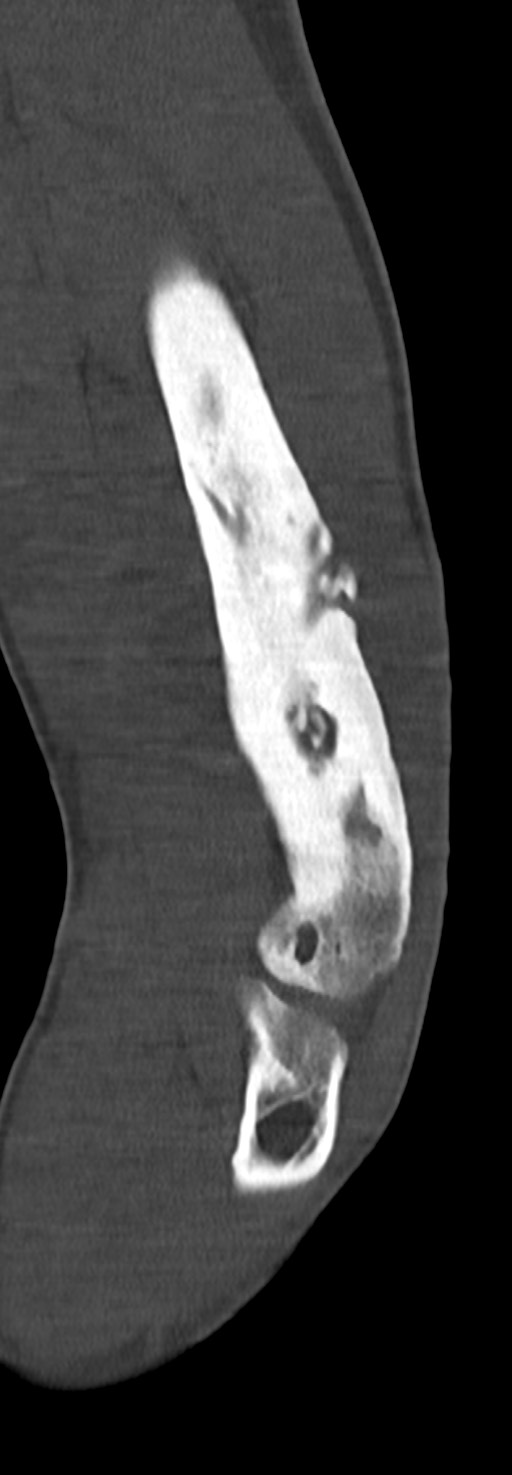 Chronic osteomyelitis of the distal humerus (Radiopaedia 78351-90971 Sagittal bone window 49).jpg