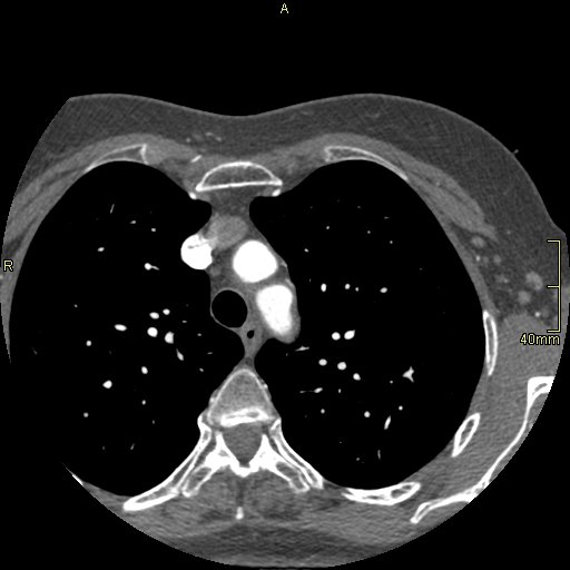 Chronic pulmonary embolism (Radiopaedia 73073-85094 Axial C+ CTPA 12).jpg