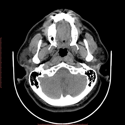Chronic submandibular sialolithiasis (Radiopaedia 69817-79814 Axial non-contrast 32).jpg