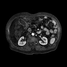 Cirrhosis and hepatocellular carcinoma in the setting of hemochromatosis (Radiopaedia 75394-86594 Axial T1 C+ fat sat 107).jpg
