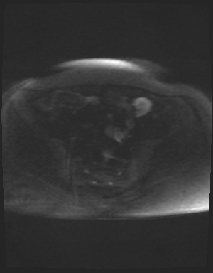 Class II Mullerian duct anomaly- unicornuate uterus with rudimentary horn and non-communicating cavity (Radiopaedia 39441-41755 Axial DWI 73).jpg