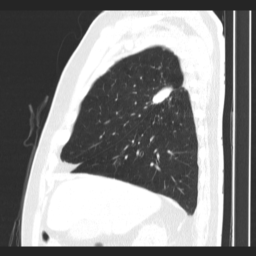 File:Classic complicated silicosis (Radiopaedia 49720-54961 Sagittal lung window 47).jpg