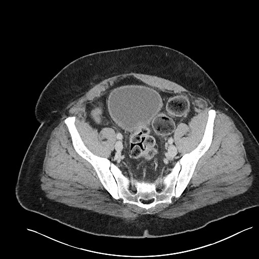 File:Closed loop obstruction - internal hernia into nephrectomy bed (Radiopaedia 59867-67320 A 116).jpg