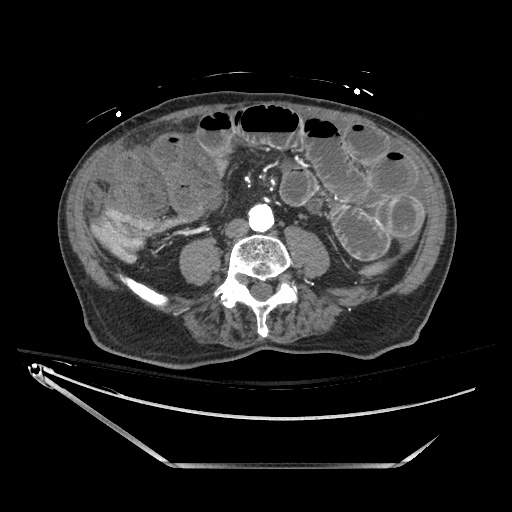 File:Closed loop obstruction due to adhesive band, resulting in small bowel ischemia and resection (Radiopaedia 83835-99023 B 90).jpg