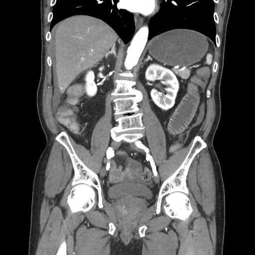 File:Closed loop obstruction due to adhesive band, resulting in small bowel ischemia and resection (Radiopaedia 83835-99023 C 73).jpg