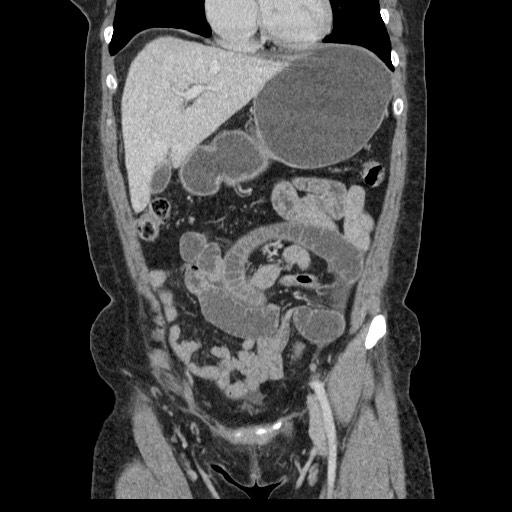 File:Closed loop small bowel obstruction (Radiopaedia 65403-74451 B 41).jpg