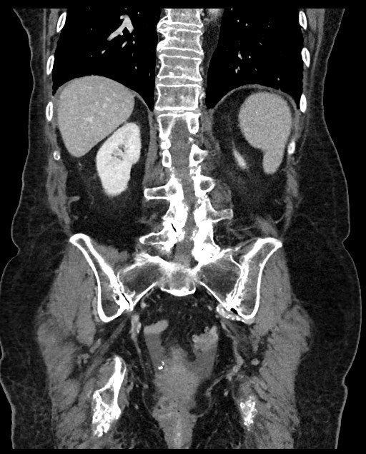 Closed loop small bowel obstruction - adhesions (Radiopaedia 59269-66611 B 91).jpg