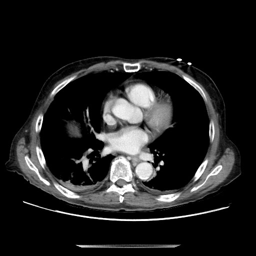 File:Closed loop small bowel obstruction - adhesive disease and hemorrhagic ischemia (Radiopaedia 86831-102990 A 12).jpg