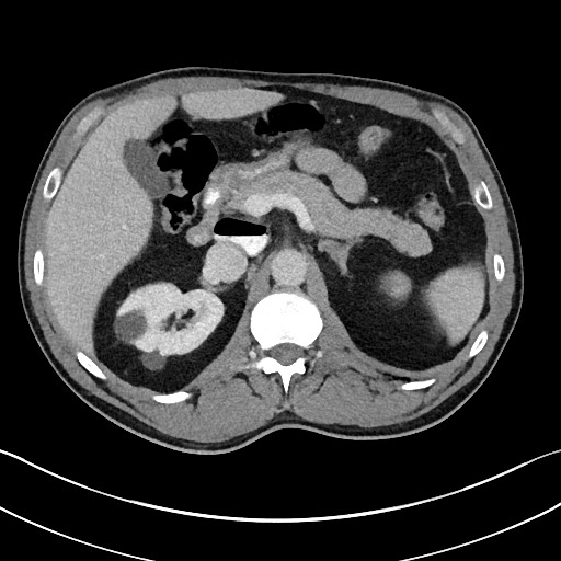 File:Closed loop small bowel obstruction - internal hernia (Radiopaedia 57806-64778 B 38).jpg