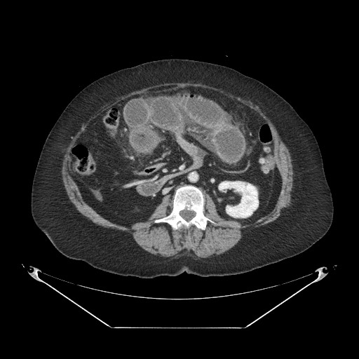 Closed loop small bowel obstruction - internal hernia (Radiopaedia 65402-74450 A 62).jpg