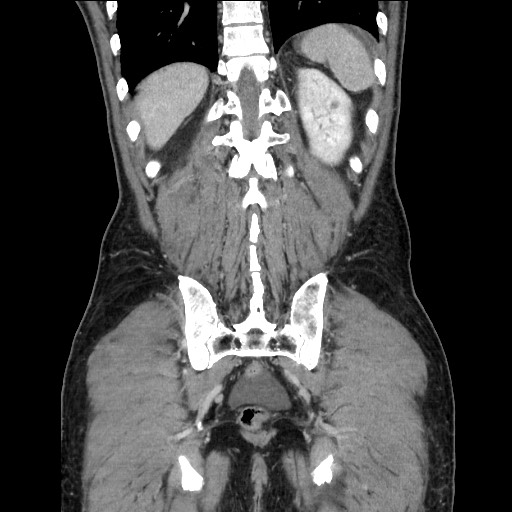 Closed loop small bowel obstruction - omental adhesion causing "internal hernia" (Radiopaedia 85129-100682 B 103).jpg