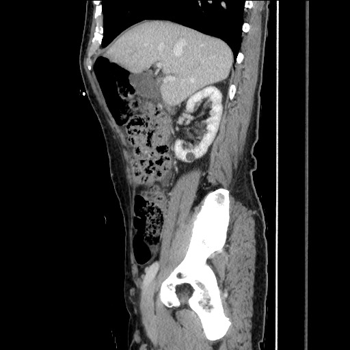 Closed loop small bowel obstruction - omental adhesion causing "internal hernia" (Radiopaedia 85129-100682 C 64).jpg