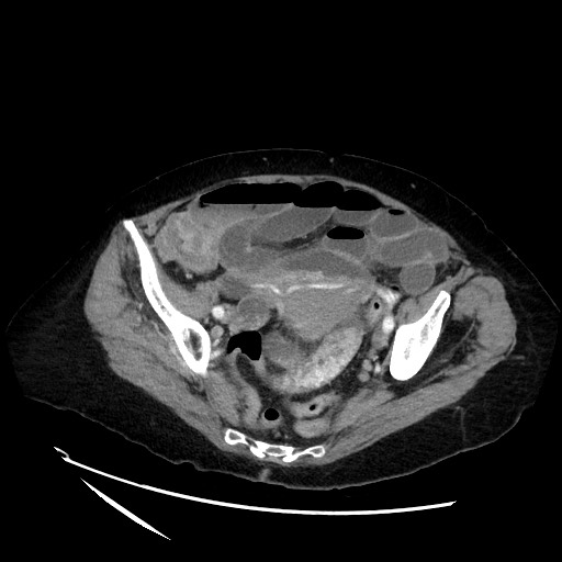 File:Closed loop small bowel obstruction due to adhesive band, with intramural hemorrhage and ischemia (Radiopaedia 83831-99017 Axial 80).jpg