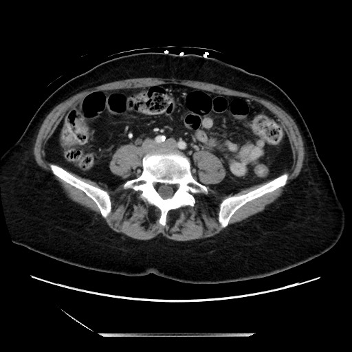 Closed loop small bowel obstruction due to adhesive bands - early and late images (Radiopaedia 83830-99014 A 94).jpg