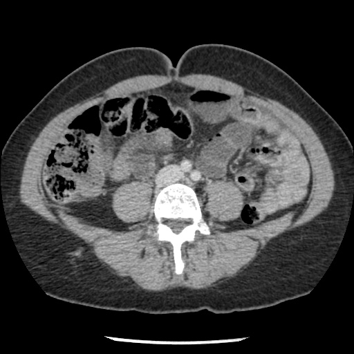 Closed loop small bowel obstruction due to trans-omental herniation (Radiopaedia 35593-37109 A 52).jpg