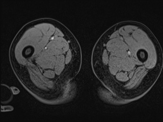 Closed loop small bowel obstruction in pregnancy (MRI) (Radiopaedia 87637-104031 G 58).jpg