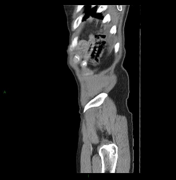 Closed loop small bowel obstruction with ischemia (Radiopaedia 84180-99456 C 86).jpg