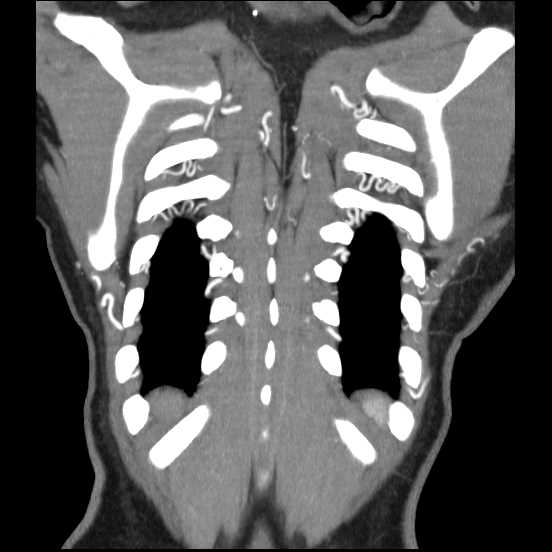 File:Coarctation of the aorta (Radiopaedia 67609-77010 B 8).jpg