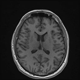 File:Cochlear incomplete partition type III associated with hypothalamic hamartoma (Radiopaedia 88756-105498 Axial T1 116).jpg