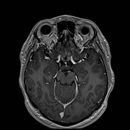 Cochlear incomplete partition type III associated with hypothalamic hamartoma (Radiopaedia 88756-105498 Axial T1 C+ 84).jpg