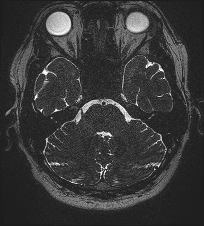 Cochlear incomplete partition type III associated with hypothalamic hamartoma (Radiopaedia 88756-105498 Axial T2 90).jpg