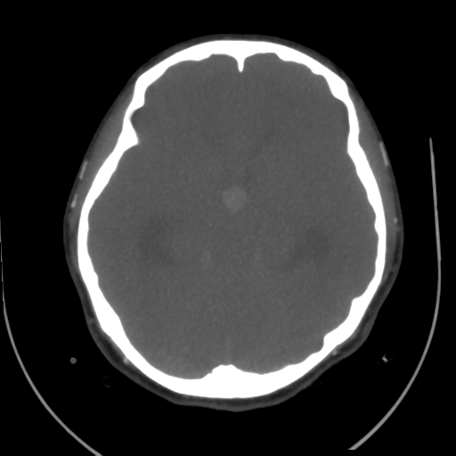 File:Colloid cyst (resulting in death) (Radiopaedia 33423-34499 A 24).png