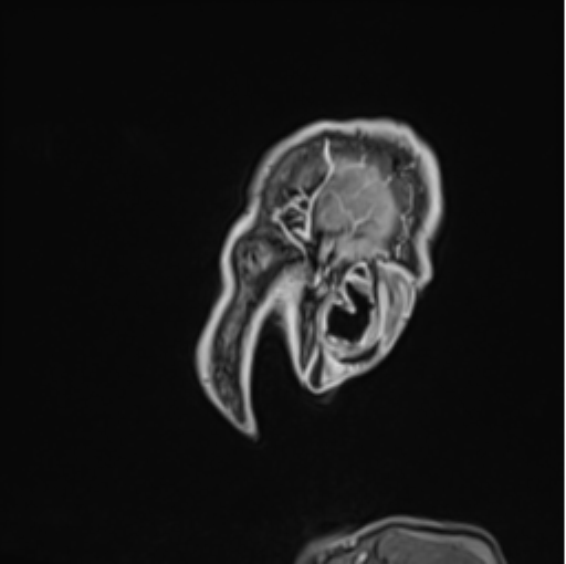 Colloid cyst of the third ventricle (Radiopaedia 86571-102662 Sagittal T1 C+ 75).png